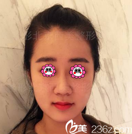 北京西美硅胶假体隆鼻案例