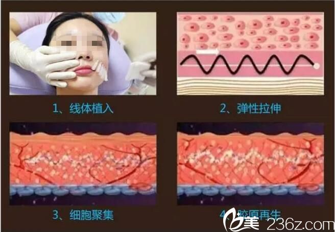 面部线雕的操作原理 面部线雕的操作原理