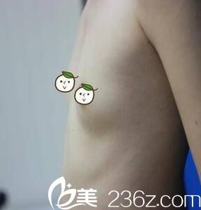 淮北微悦牟少春假体隆胸真人案例效果图 淮北微悦牟少春假体隆胸真人案例效果图