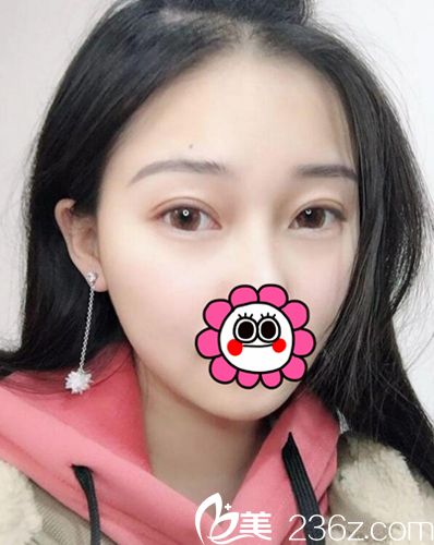 真人自述在武汉米兰整形医院割了双眼皮后人生就像走向了另一条道路