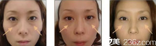 去眼袋手术 去眼袋手术