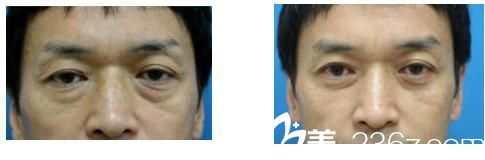 眼睑下垂 眼睑下垂