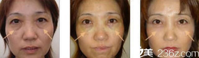 眼睛下部松弛 眼睛下部松弛