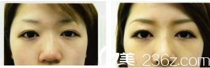 鼻尖形成术 鼻尖形成术