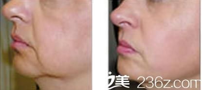 高周波治疗 高周波治疗