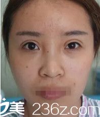 术前面部凹陷显老 术前面部凹陷显老