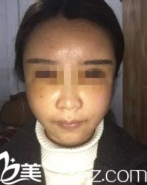 刚做完填充过后面部肿胀 刚做完填充过后面部肿胀