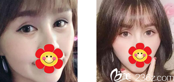 呼和浩特紫洁整形去眼袋<span style= 呼和浩特紫洁整形去眼袋<span style=