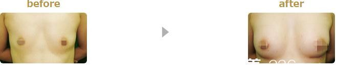 自体脂肪丰胸