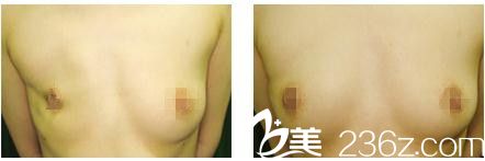乳房再建_副本.jpg