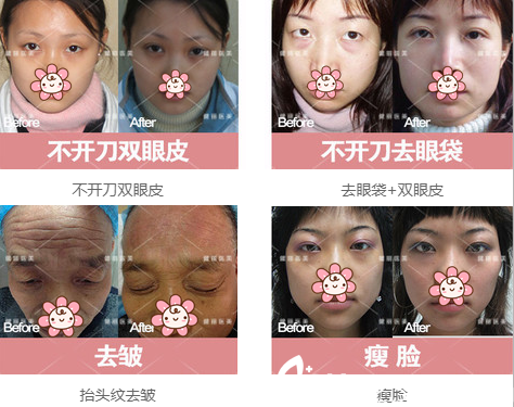 成都健丽双眼皮去眼袋<span style= 成都健丽双眼皮去眼袋<span style=