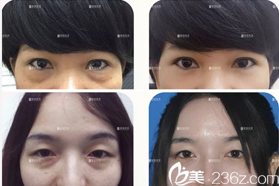 成都健丽赵波涛去眼袋案例