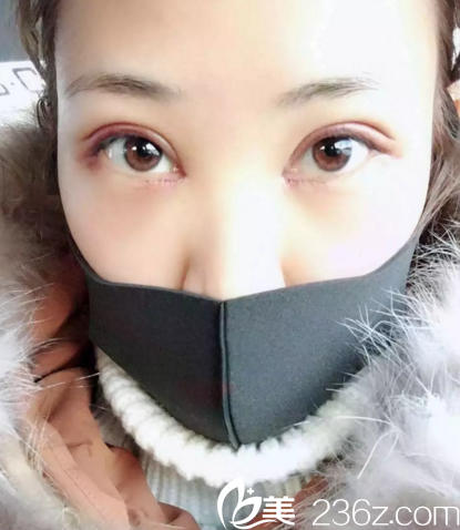 在长春中妍做双眼皮+开眼角术后2天