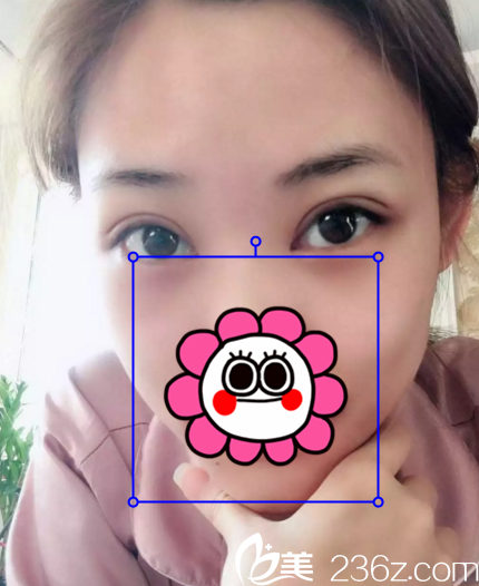 在长春中妍做双眼皮+开眼角术后10天