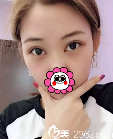 在长春中妍做双眼皮+开眼角术后15天