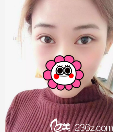 在长春中妍做双眼皮+开眼角术后21天