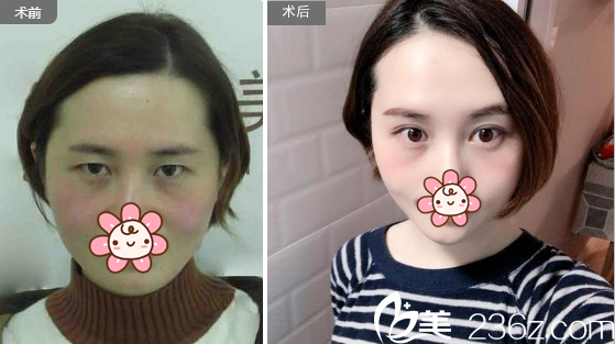 成都健丽葛振国双眼皮案例 成都健丽葛振国双眼皮案例