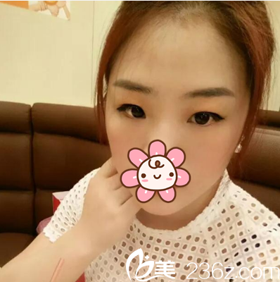 做双眼皮术前照片 做双眼皮术前照片