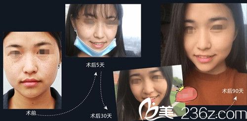 <!--<i data=20240703-sp></i>-->美莱整形医院激光祛雀斑案例