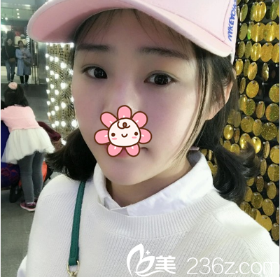 成都健丽双眼皮术后半个月 成都健丽双眼皮术后半个月