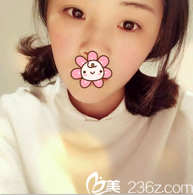 赵波涛定点双眼皮术后一个月 赵波涛定点双眼皮术后一个月