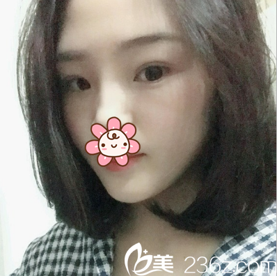 镭射定点定位双眼皮术后2个月 镭射定点定位双眼皮术后2个月