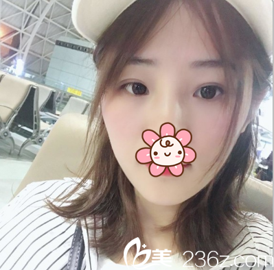 来一发成都健丽赵波涛镭射定点定位双眼皮术后反馈 恢复无切口