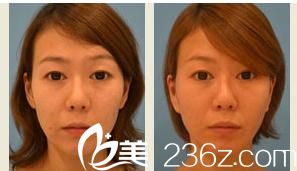 面颊吸脂 面颊吸脂