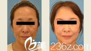 整体拉皮手术 整体拉皮手术