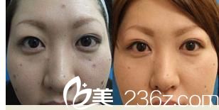 埋线双眼皮 埋线双眼皮