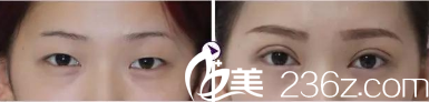 淮北东方美莱坞双眼皮案例