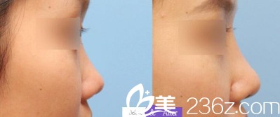 淮北东方美莱坞隆鼻案例