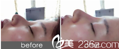 淮北时光假体隆鼻真人案例