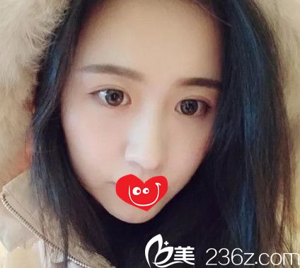 肋软骨隆鼻7天拆线后鼻子微肿