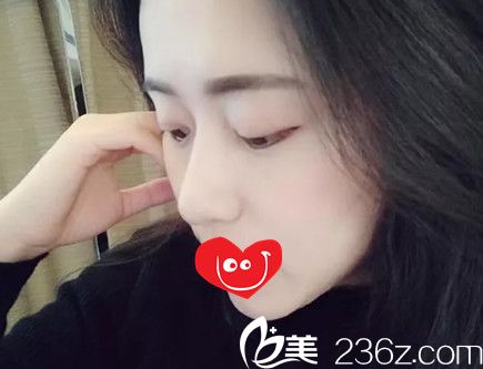 术后16天鼻子慢慢恢复中