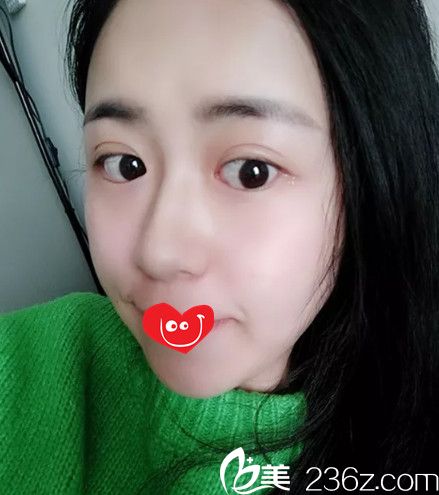 肋软骨隆鼻23天鼻子消肿很多