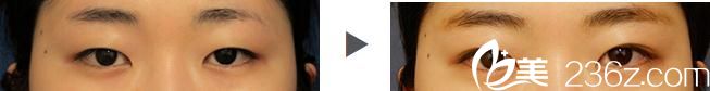 埋线双眼皮
