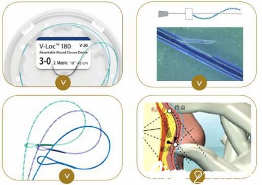 苏州康美可做的线雕隆鼻采用蛋白线
