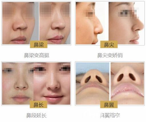 刘英医生线雕隆鼻案例