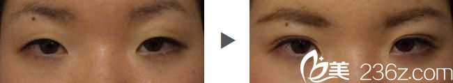 埋线双眼皮展示