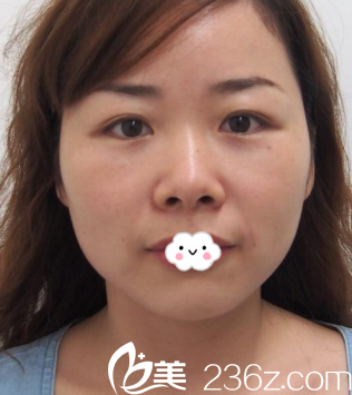 东营艺美李琳膨体隆鼻综合整形案例 东营艺美李琳膨体隆鼻综合整形案例