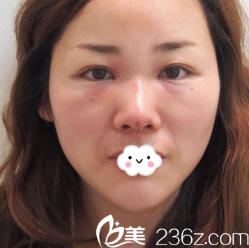 东营艺美李琳假体隆鼻真人案例 东营艺美李琳假体隆鼻真人案例