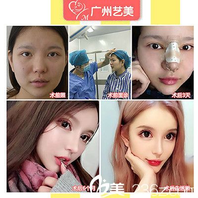 广州艺美李闯院长做的李氏3C翘鼻术案例 广州艺美李闯院长做的李氏3C翘鼻术案例