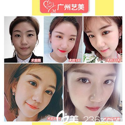 广州艺美张涛院长做的切开双眼皮案例 广州艺美张涛院长做的切开双眼皮案例