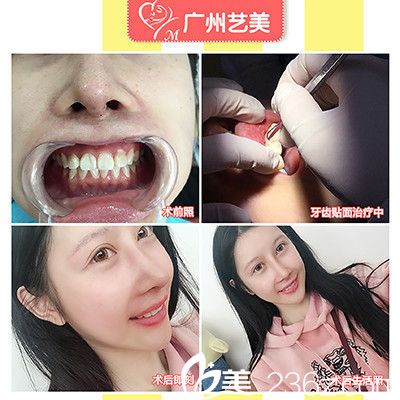 广州艺美袁媛做的牙贴面真人案例 广州艺美袁媛做的牙贴面真人案例