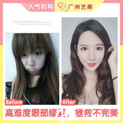 广州艺美张涛院长做的双眼皮失败修复案例 广州艺美张涛院长做的双眼皮失败修复案例