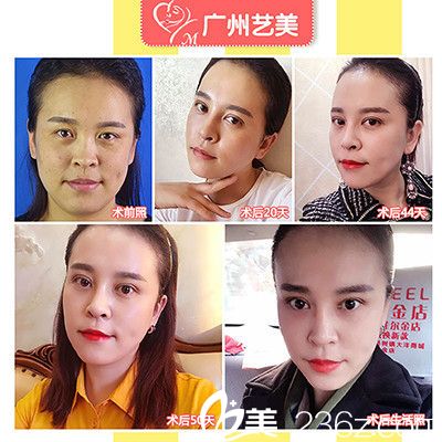 广州艺美张涛院长面部<span style= 广州艺美张涛院长面部<span style=