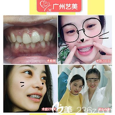 广州艺美袁媛主任做的牙齿矫正案例 广州艺美袁媛主任做的牙齿矫正案例