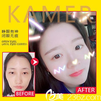 广州可玫尔整形医院<!--<i data=20240703-sp></i>-->诚做的双眼皮和脂肪填充 广州可玫尔整形医院<!--<i data=20240703-sp></i>-->诚做的双眼皮和脂肪填充