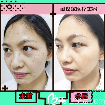 广州可玫尔医疗美容整形医院超皮秒祛斑 广州可玫尔医疗美容整形医院超皮秒祛斑